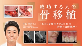 サイナスフロアエレベーション アルティメットガイド 全てを満たす究極